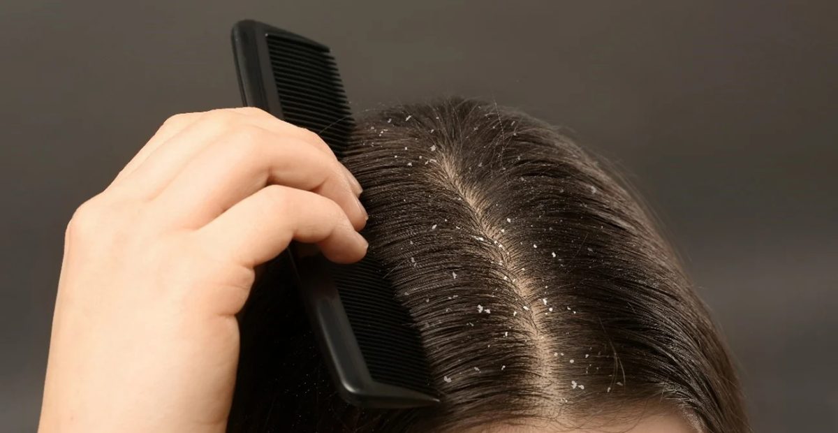 6 Natural Ways to Get Rid of Dandruff